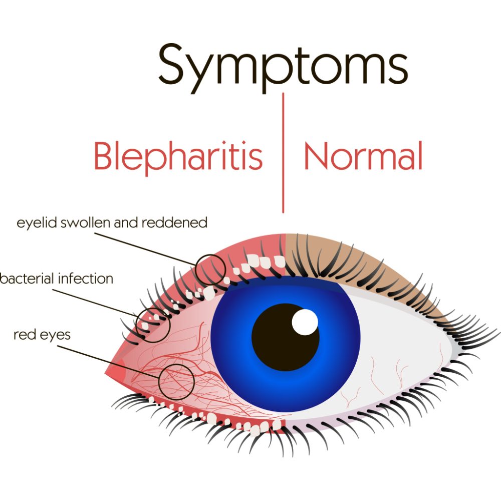 Blepharitis Heyes Opticians 