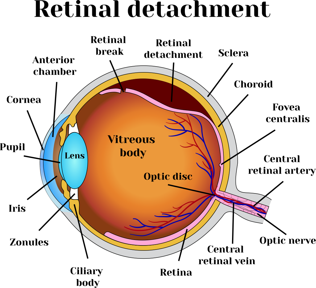 Retinal Detachment - Heyes Opticians